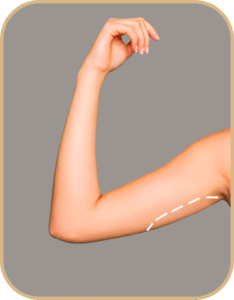 braquioplastia