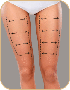 lipolifting de cocha