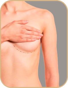 mamoplastia redutora
