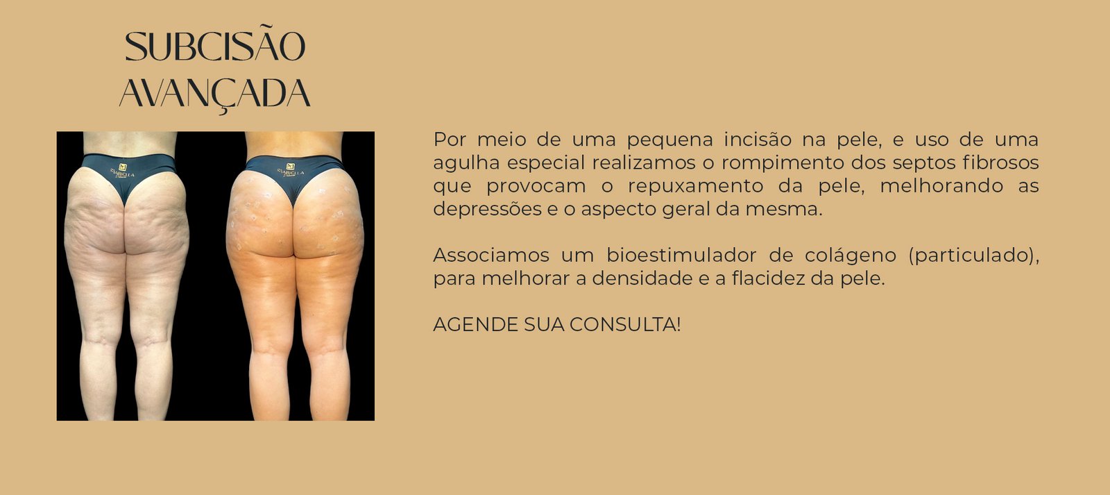 subcisão avançada